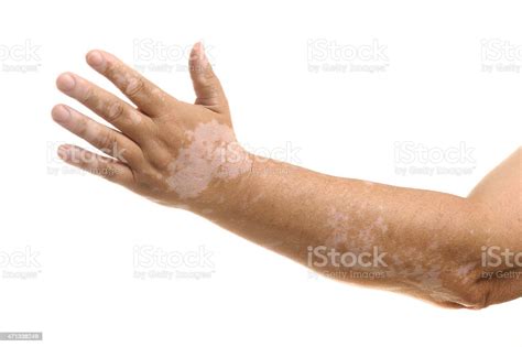 vitiligo fotos|13 000+ Vitiligo Photos, taleaux et images libre de。